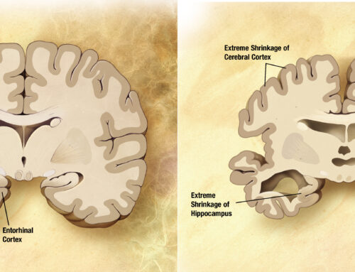 The Challenge of Defining Alzheimer Disease Based on Biomarkers in the Absence of Symptoms