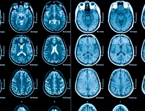 Human brains are getting larger. That may be good news for dementia risk.